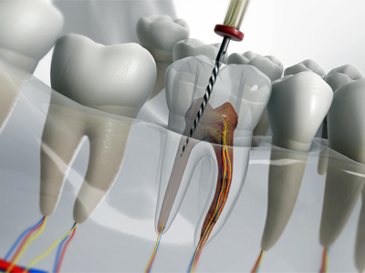 Root Canal Treatment